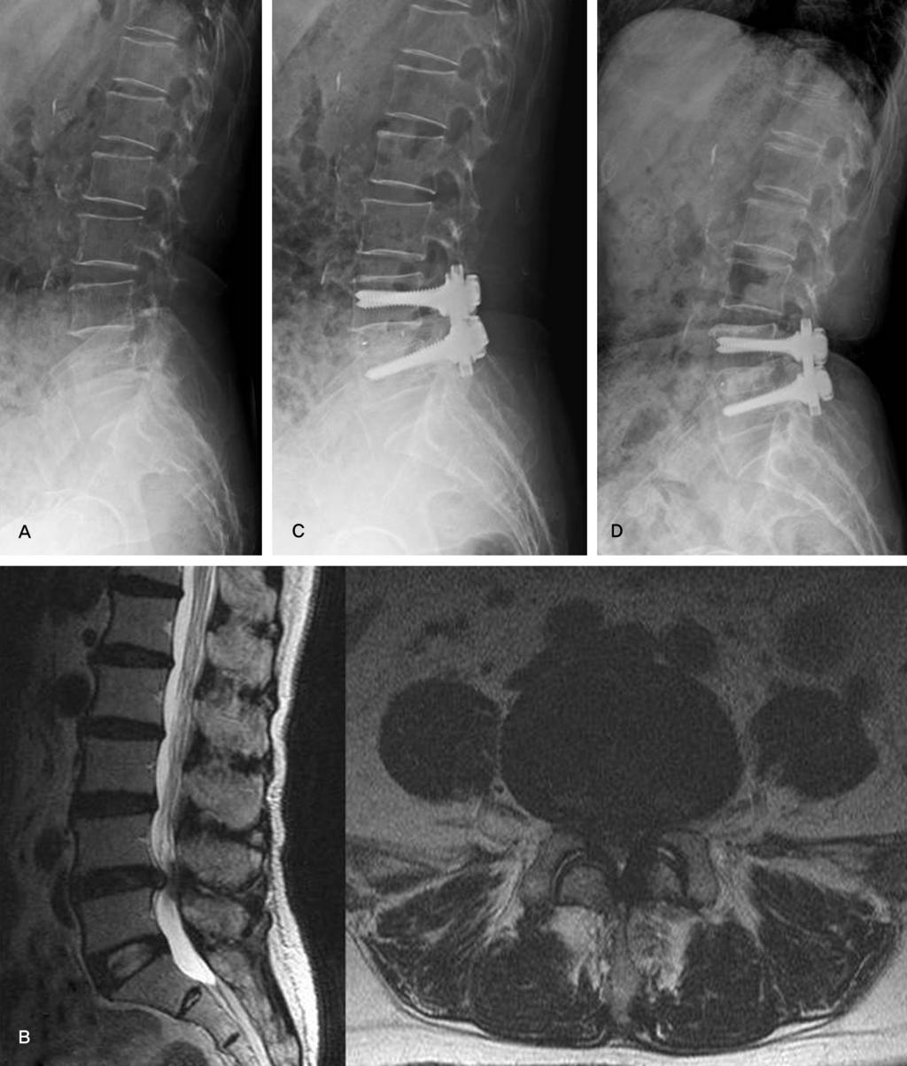 Kyung-Jin Song et al Volume 18 Number 4 December 2011 Fig. 1. A 69-year-old female presented with back pain, sciatica and neurogenic claudication.
