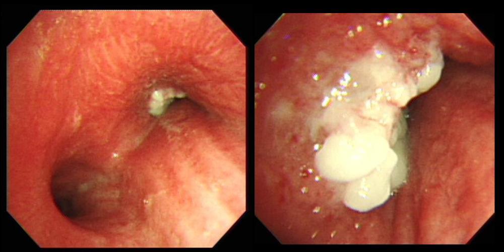 DOI: 10.3947/ic.2011.43.1.76 Infect Chemother 2011;43(1):76-81 77 금까지국내에발표된증례들을문헌조사하여임상적특징등을알아보고자하였다.