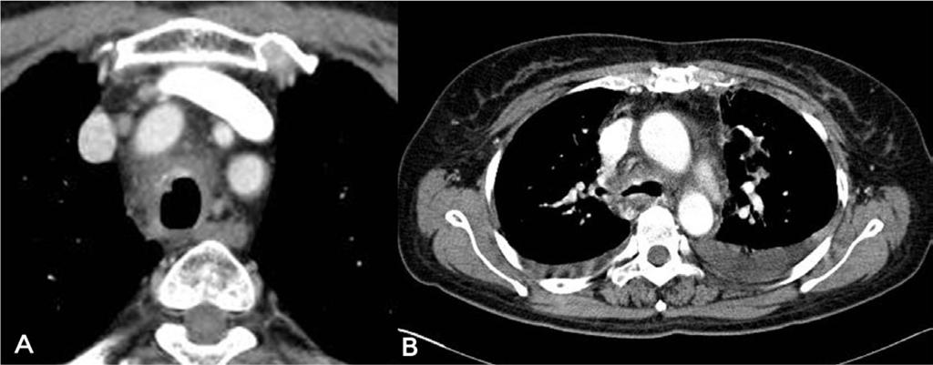 78 JK Choi, et al. Invasive Tracheobronchial Aspergillosis Figure 2. CT scan of the chest.