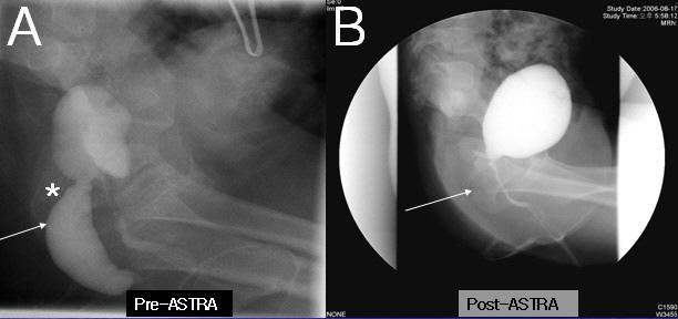 78 소아외과제 13 권제 1 호 2007 년 Fig. 3. Pre (A) and post (B)-operative voiding cystourethrogram: A, urethrovaginal fistula is shown (asterisk).
