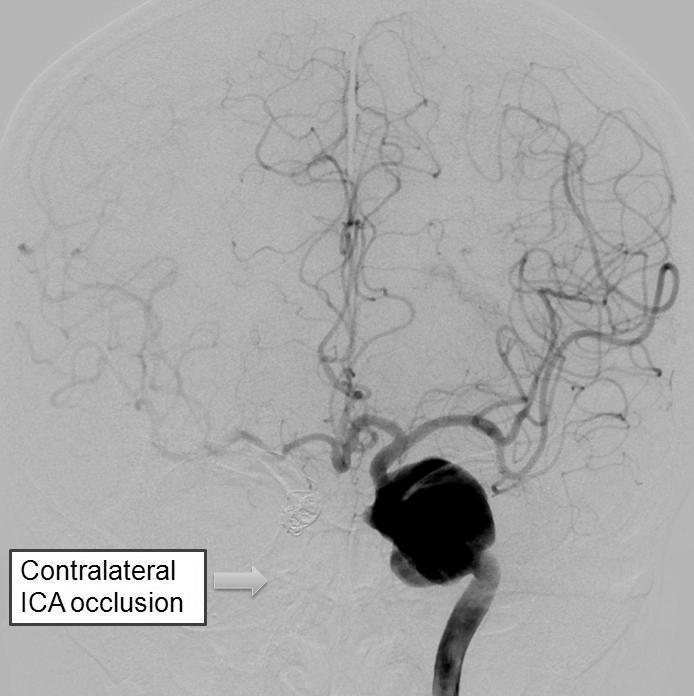 A B C D Fig. 2. A case of 65-year-old female who presented with diplopia due to sixth nerve palsy.