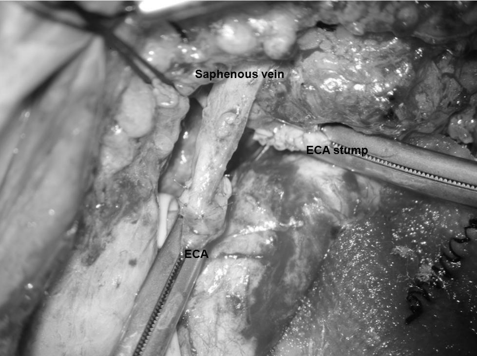 Note the end of the saphenous vein was sutured to the end of the ECA. Another ECA stump was sutured.