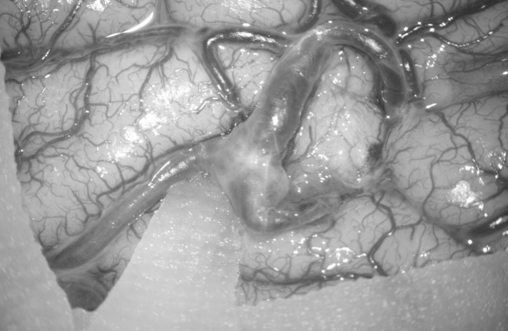 (B) Intraoperative photograph shows a fusiform aneurysm at the cortical branch of the MCA. (C) Intraoperative photograph of the harvested radial vein.
