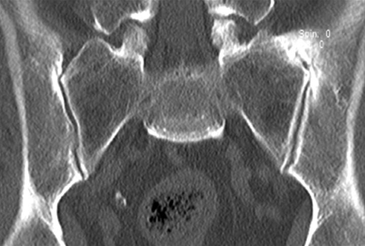 (B) The sacrum CT revealed irregularity of the articular surface of the lower portion of the left SI joint with possible erosions and pseudo-widening of the joint space, and all this is compatible