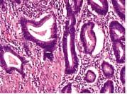 일본의분류에서는 carcinoma in situ (CIS) 를인정하지않는다. 궤양에의해근육층이소실된부위에종양이있으면 subserosa 침범으로판정한다.