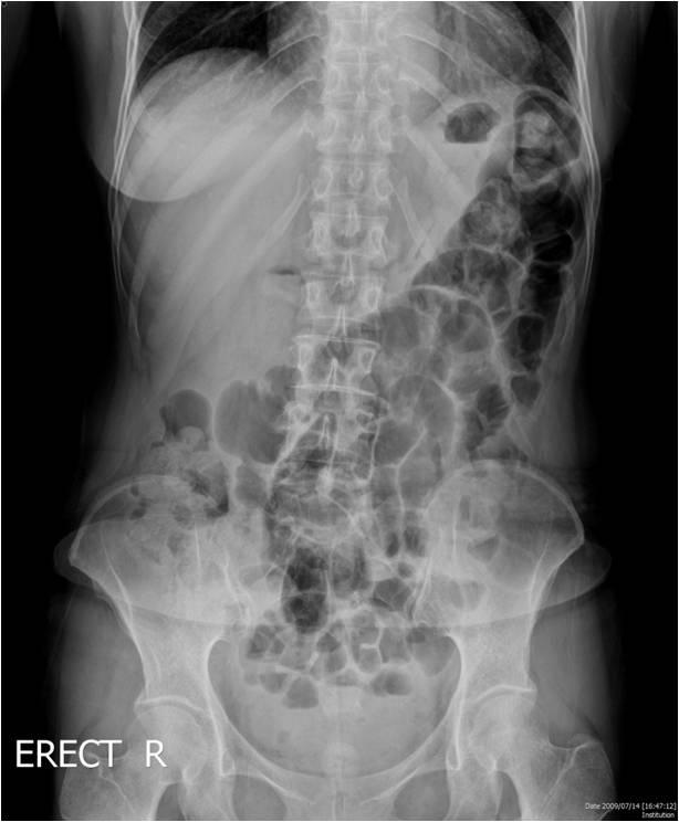 - The Korean Journal of Medicine: Vol. 81, No. 2, 2011 - 증상이호전되어특별한검사나치료는받지않았다. 한달에한두번증상이발생하였고, 여러병원을다니며대증치료를받으면서악화와호전을반복해왔다. 일주일전부터다시오심과구토를동반한심한통증이있어타병원을방문하여대증치료를하였으나이번에는증상이호전되지않고더악화되어본원응급실에내원하였다.