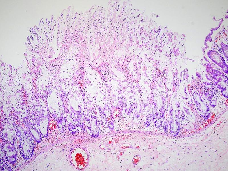 114 대한소화기내시경학회지 2008;6:112-116 Figure 5. Microscopic finding. Colonic mucosa shows superficial erosion and attached pseudomembrane composed of fibrin, mucus, and inflammatory debris (H&E stain, 100).