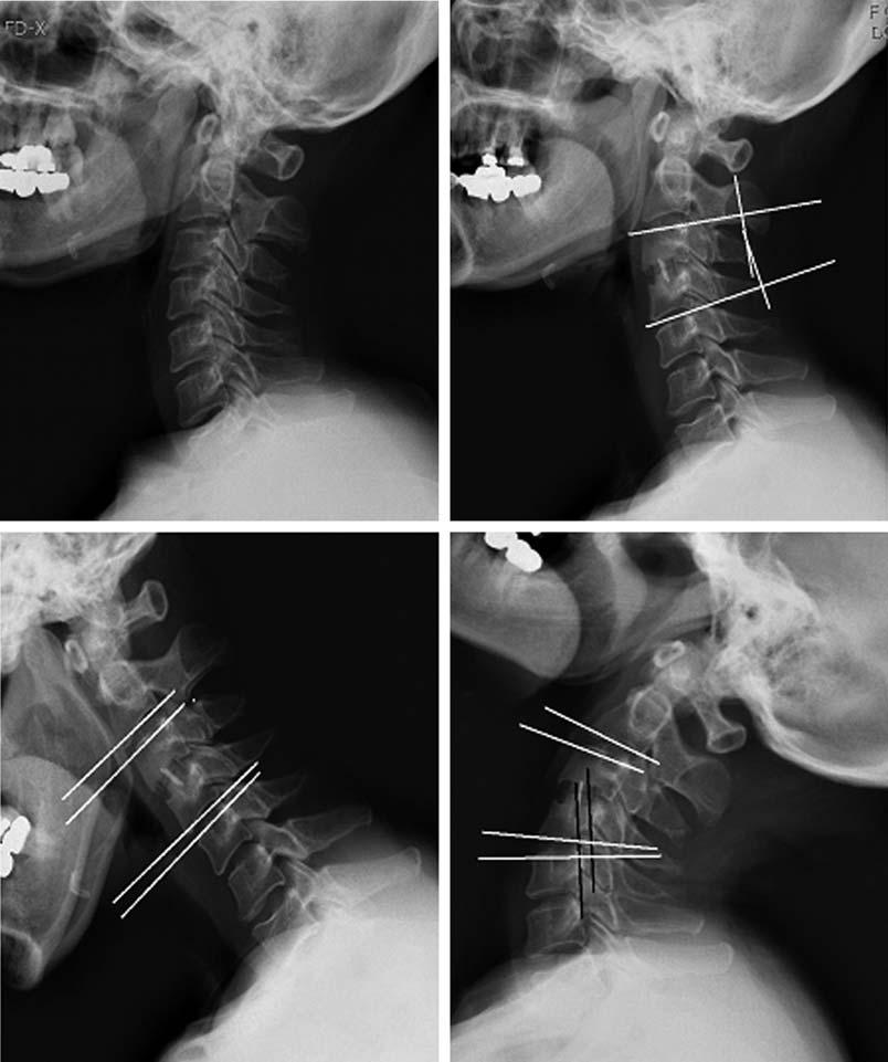 대한척추외과학회지 Vol. 15, No. 4, 2008 Fig. 3. A 42-year-old woman, disc herniation at C3-4 and treated with anterior cervical disectomy and fusion.
