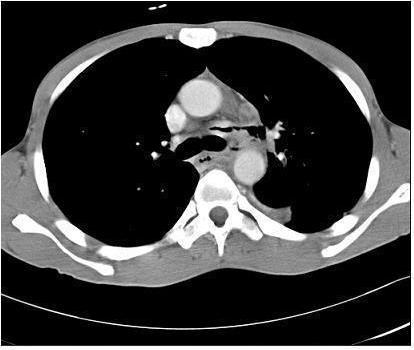 Figure 3. Esophagogram shows an irregular barium leakage outline the fistular in mid esophagus. Figure 2.