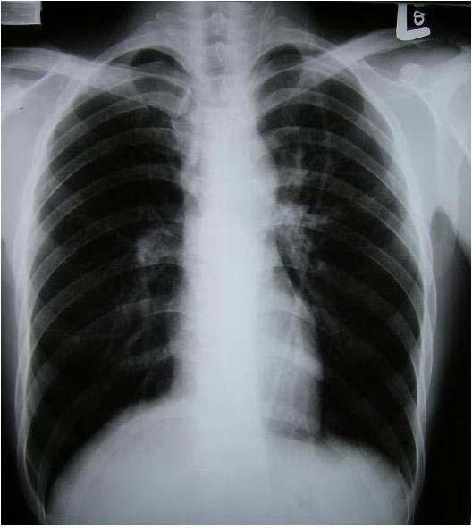 Contrast enhanced CT scan shows linear or oval gas collections in an enlarged left lower paratracheal lymph node.