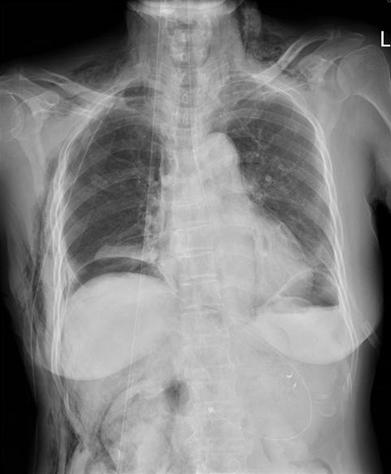 This panel shows the right-sided pneumothorax, subcutaneous emphysema, and free air at the