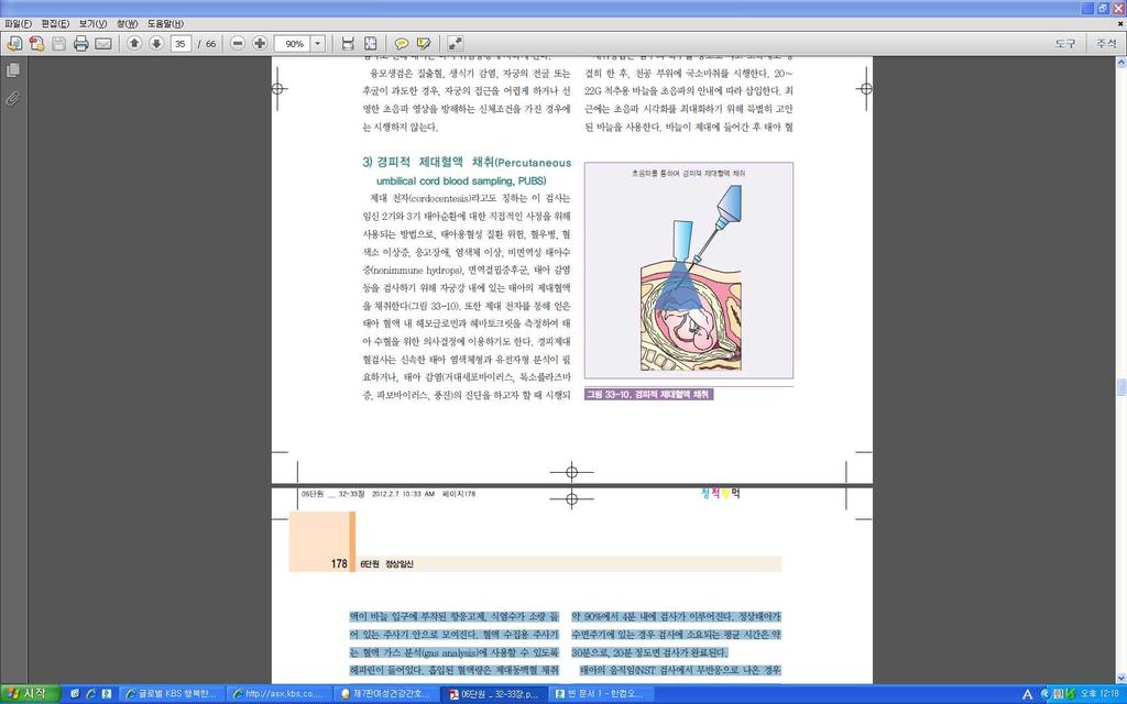 (3) 양수평가 인지질 빌리루빈 ( 동종면역임신사정 ) 태아의폐성숙사정 L/S 비율분석 -스핑고마이엘린의농도는상대적으로일정하지만, 레시킨의상승으로 L/S 비율이증가하면 계면활성제생산증가의미 -L/S 2.0 이면폐성숙이이루어졌다고봄 쉐이크검사 -에틸알코올 1cc와양수 1cc를혼합하여흔든후표면에거품이생기는것으로평가하는방법 -L/S 2.