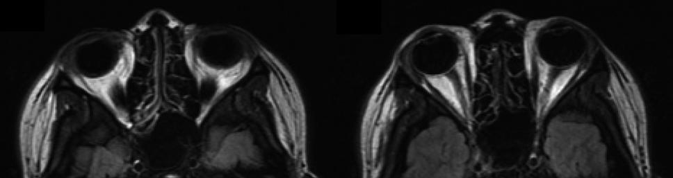 - Bo Young Kim, et al. Antiphospholipid syndrome with Bell palsy - A B 월경과후다시임신을하였으며현재아스피린과저분자헤파린투여하며성공적으로출산을하였다. 고 찰 Figure 2.