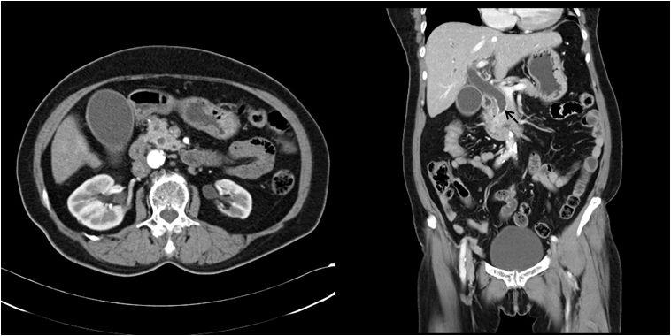 57 Fig. 1. Abdomen CT showed a narrow common bile duct with upstream dilatation.