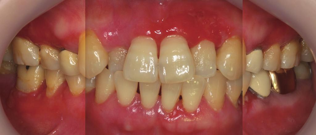 Effect of supportive periodontal treatment in the oral lichen planus patients 망상형은백색병소를대표하며, 이것은백색선을연결하여엮은네트워크로보인다. 비록몇몇환자들은방산형으로넓게퍼진망상형병소의인상적인배열을가지고있으나, 대개는증상을호소하는경우가거의없고, 종종존재자체를인지하지못하는경우도있다.