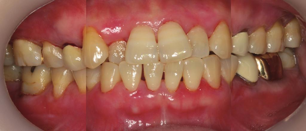 Effect of supportive periodontal treatment in the oral lichen planus patients Fig. 4. Posttreatment at 6 month of case 1.