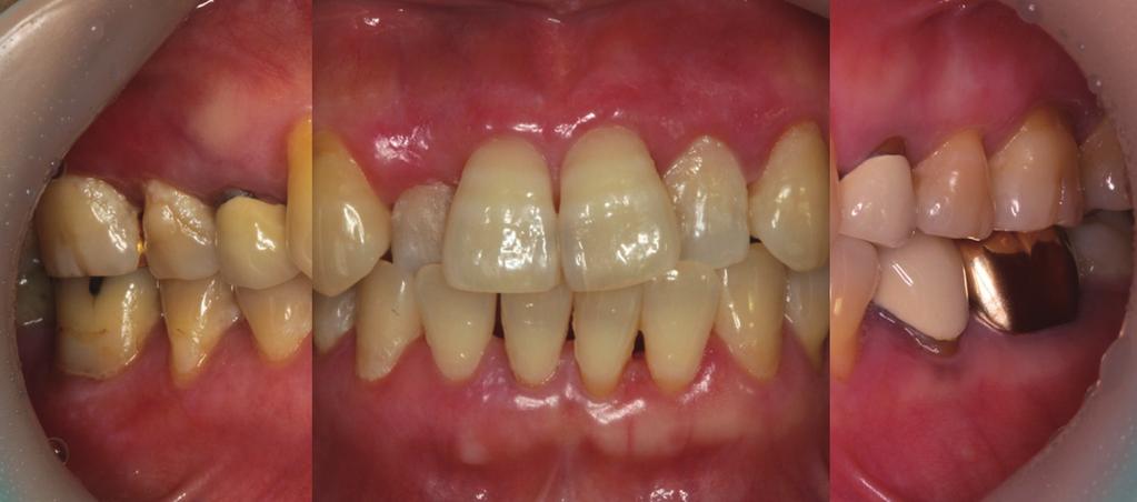 Note no relapse of oral lichen planus and maintenance of gingival health. 2. 증례 2 56세의여자환자로구강편평태선으로구강내과에서지속적인치료를받고있으나, 계속되는치은통증과치은부종으로치주과로의뢰되었다.