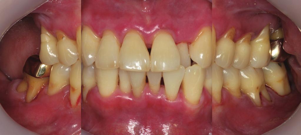 molar areas. Fig. 7. Pretreatment radiograph of case 2.