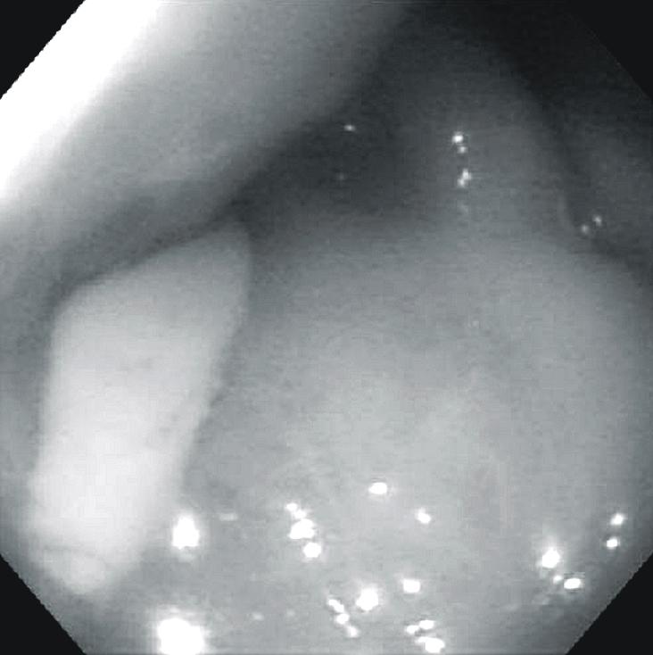 gastrosplenic fistula tract (a), Gastrofibroscopy shows draining pus through gastrosplenic fistula in thickened fundic fold (b).