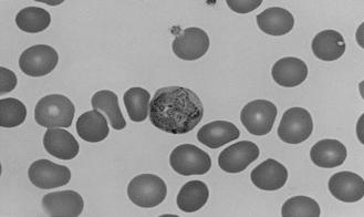 306 김자영 임지향 김명신외 4 인 N P.v P.f A B C Fig. 1. (A) P. vivax, gametocytes in enlarged RBC. Giemsa stain ( 1,000). (B) P. falciparum, numerous ringform trophozoits in RBCs. Giemsa stain ( 1,000). (C) OptiMAL test: N, negative (control band only); P.