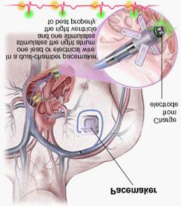 심전도 (ECG) 심전도는심장의수축에따르는활동전위의시간적변화를그래프에기록한도면으로서심근이흥분되면막의탈분극이생기고