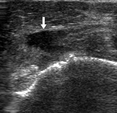 337 Figure 6. Ultrasonography (US) findings of rupture of tendon.