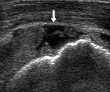 SSP, supraspinatus tendon. Figure 7. Ultrasonography findings of calcific tendinitis of the shoulder.