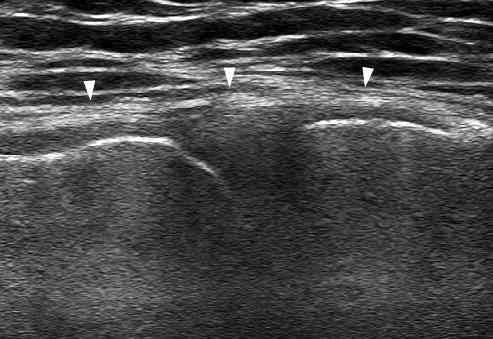 Long axis ultrasonography image of the posterior shoulder shows a triangular hyperechoic posterior labrum (L). H, humeral head; G, glenoid.
