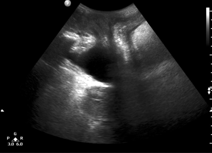 J Surg Ultrasound Vol. 2, No. 2, 2015 Fig. 4.
