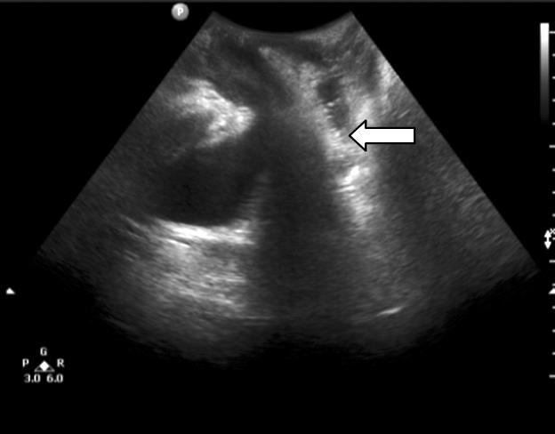 Hyeon-Keun Shin: Transperineal Ultrasonography for the Pelvic Floor Disorders in the Aspect of Colorectal Surgeon Fig. 7.