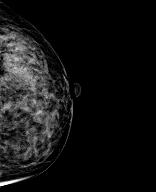 American College of Radiology) 의팬텀 (phantom) 인 RMI 156을사용하여평가한다. ACR 팬텀은그림 15과같이만들어져있으며 4.2cm 두께로, 50% 의실질과 50% 의지방질로구성된유방과같은밀도로구성되어있다.