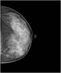 [ 그림 17] 구현된디지털유방 X- 선촬영기로획득되고영상처리된영상 [Fig. 17] mammogram of implemented digital mam m og raphy [ 그림 18] 병원에서사용중인디지털유방 X- 선촬영기 1 의영상 [Fig.