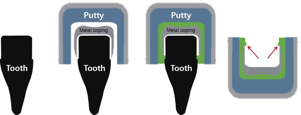 Study on methodology for the assessment of internal and marginal adaptation on fixed dental prosthesis 폭경길이를확인하여보철물의예후를평가하는데용이하다는장점이있다. 23 하지만이방법은치아근원심부위, 즉보철물의인접면변연부위만확인이가능하며협설측변연부위는확인할수없다.