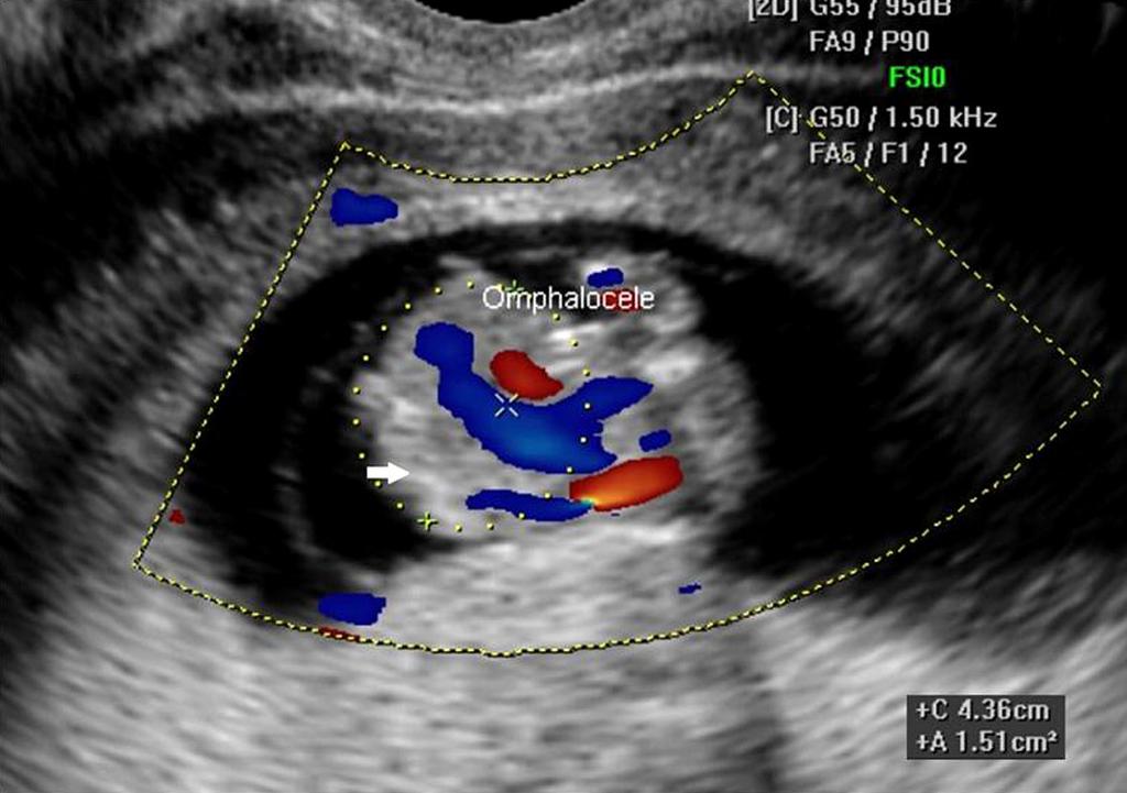 KJOG Vol. 55, No. 10, 2012 A B Fig. 1. (A) Transabdominal ultrasonographic image of the fetus showing omphalocele (arrow). (B) scoliosis (arrows).