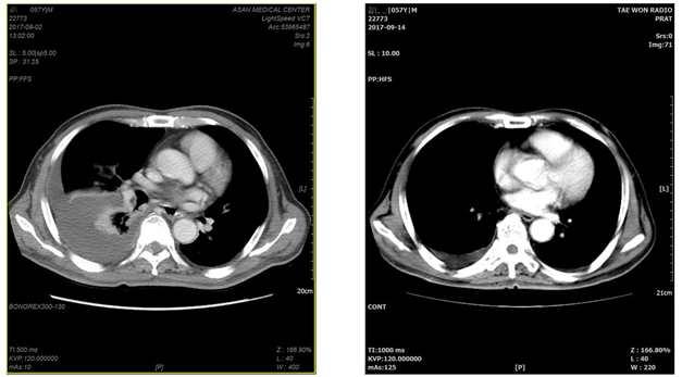 19 (A) Chest CT (2017/08/02) (B) Chest CT