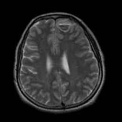 representing hyperacute-to-acute hemorrhage. Figure 1. General appearance showing multiple café au lait spots.