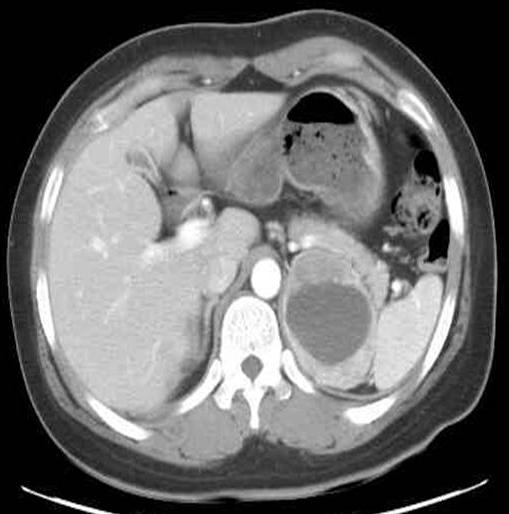 - Moo Gon Kim, et al : Spontaneous intracerebral hemorrhage in neurofibromatosis type 1 - Figure 4.