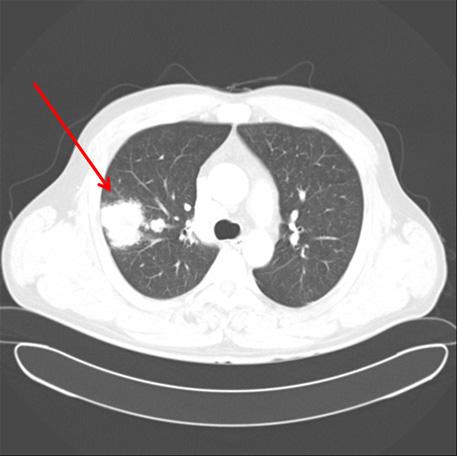 - Eul Sun Moon, et al. Recurrent Malignant Paraganglioma - Figure 1. Chest computed tomography showed a large mass in the right upper lobe and multiple nodules in both lungs that suggested metastases.
