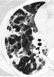 396 권건영 최원일 고성민 Fig. 9. () HRCT image at a level of the ventricle shows multiple patchy areas of consolidation, predominantly along the bronchovascular bundles and the subpleural portion.