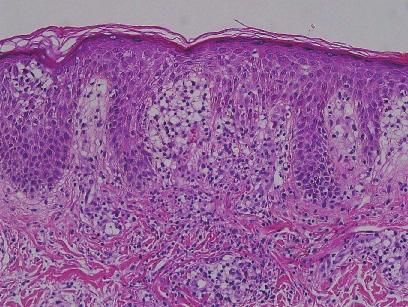 iopsy of back skin with recurred skin eruption at second admission.