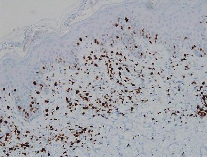 bridization 음성으로 말초 T 세포 림프종(peripheral T-cell lym- 이 보이고 해면화가 동반되었다(Fig. 5).