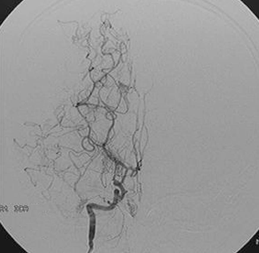 Moyamoya Disease C D Figure 4.