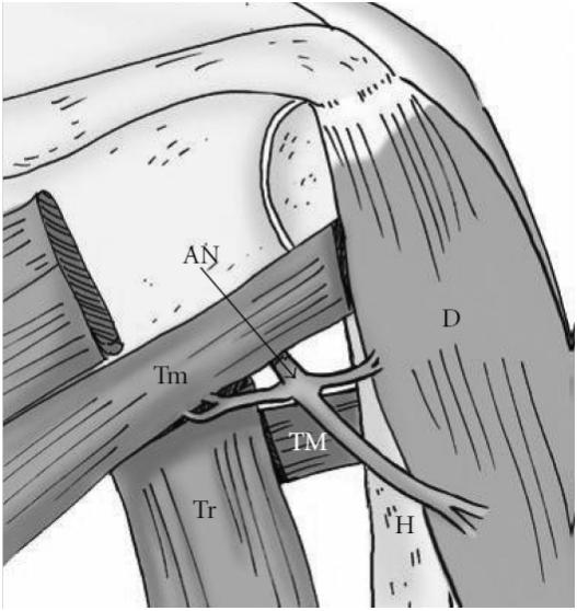 the glenoid (G), a finding that is consistent with a ganglion cyst. Note the thin neck of the cyst (arrowheads in a) directed toward the GHJ. H, humeral head.