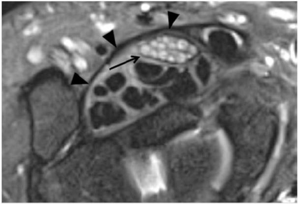 2013 년도대한통증학회추계연수교육 interosseous nerve syndrome), 회내근증후군 (pronator syndrome) 등이있으며이중수근관증후군이가장흔한질환이다. 수근관증후군은전체포착성신경병증중약 90% 를차지할정도로흔한질환이며빈도는보고에따라약 5 15% 정도로나타난타고한다.