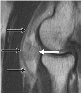 요골신경포착 (Radial nerve entrapment) 요골신경의포착성신경병증은완관절부위에서발생하는 Wartenberg 증후군이라고도하는표재요골신경의압박병증 (superficial radial nerve compression) 과주관절근처에서발생하는후골간증후군, 요골관증후군등이있다.