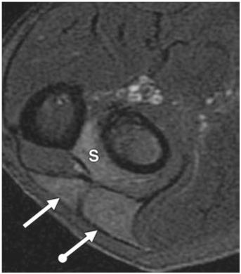 The ulnar border of the proximal carpal tunnel is delimited by the pisiform (PIS) and the contents of the Guyon canal: the ulnar artery (asterisk) and ulnar nerve (UN).