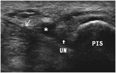 Axial fat-suppressed T2-weighted MR image shows denervation edema in posterior aspect of supinator muscle (S), extensor digitorum communis muscle (straight arrow), and extensor