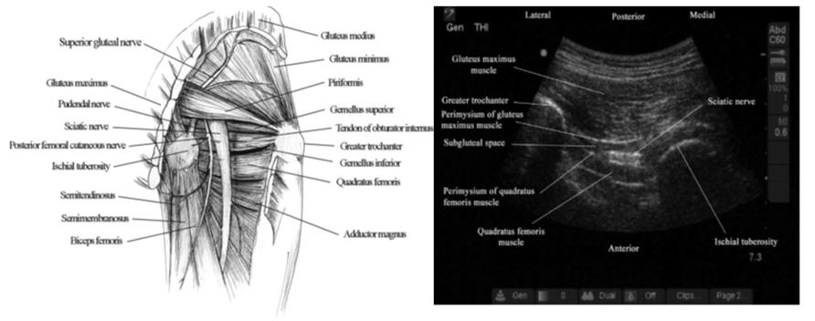 2013 년도대한통증학회추계연수교육 Entrapment and Compressive Neuropathy in Lower Extremity 분당서울대학교병원마취통증의학과 최은주 서론하지의포착성신경병증은흔하지는않으나진단이늦어지는경우가종종있다. 하지에서발생하는포착성신경병증의병인은크게두가지로나눌수있다.