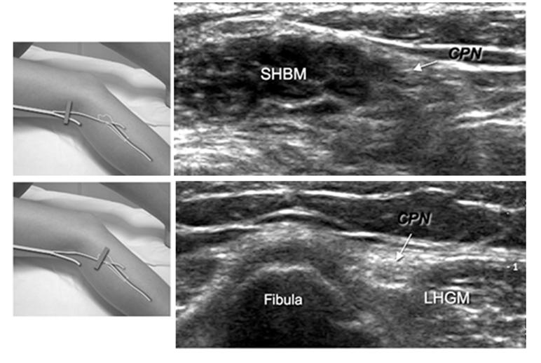 TN, tibial nerve; MHGM, medial head of the gastrocnemius muscle; PV, popliteal vessels; LHGM, lateral head of the