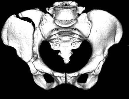 (B) Using a limited ilioinguinal approach, bone graft and 3 anterior column fixation was carried out.